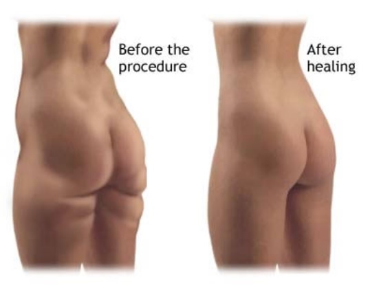 Back Lift Lipectomy Surgery Sydney - Post Weight Loss Surgery
